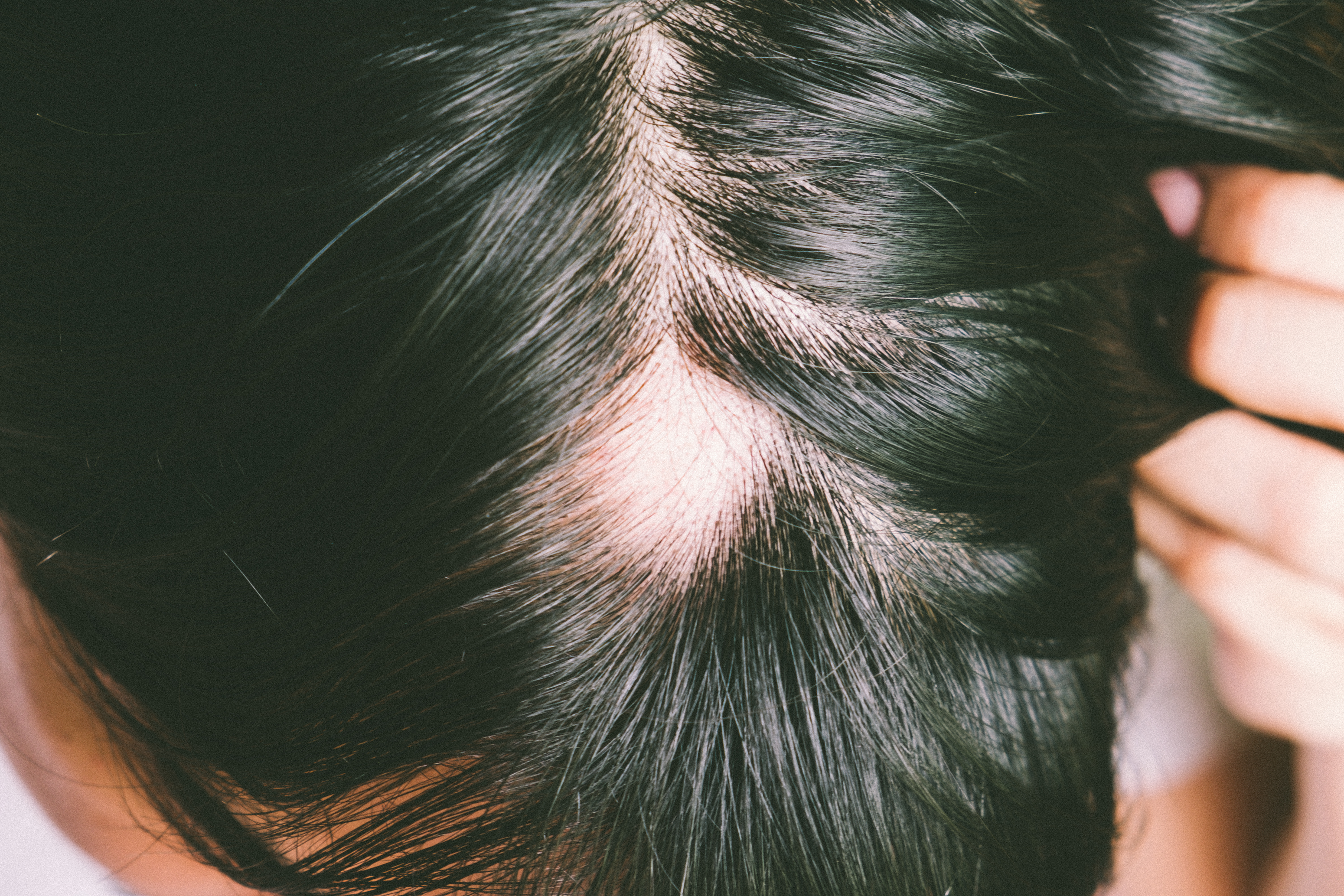 du_anaphase-_silo_hair-loss_causes_L3_header_spot baldness